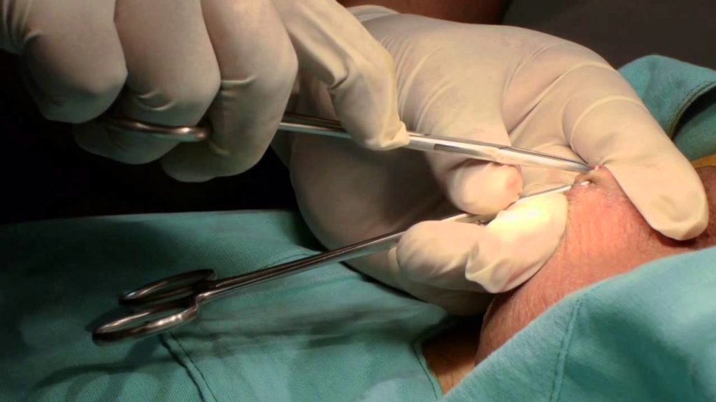 operacion-de-vasectomia