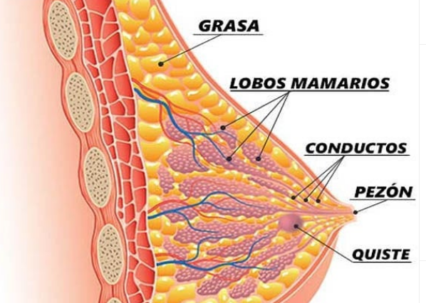 ¿Qué es la enfermedad mamaria benigna?